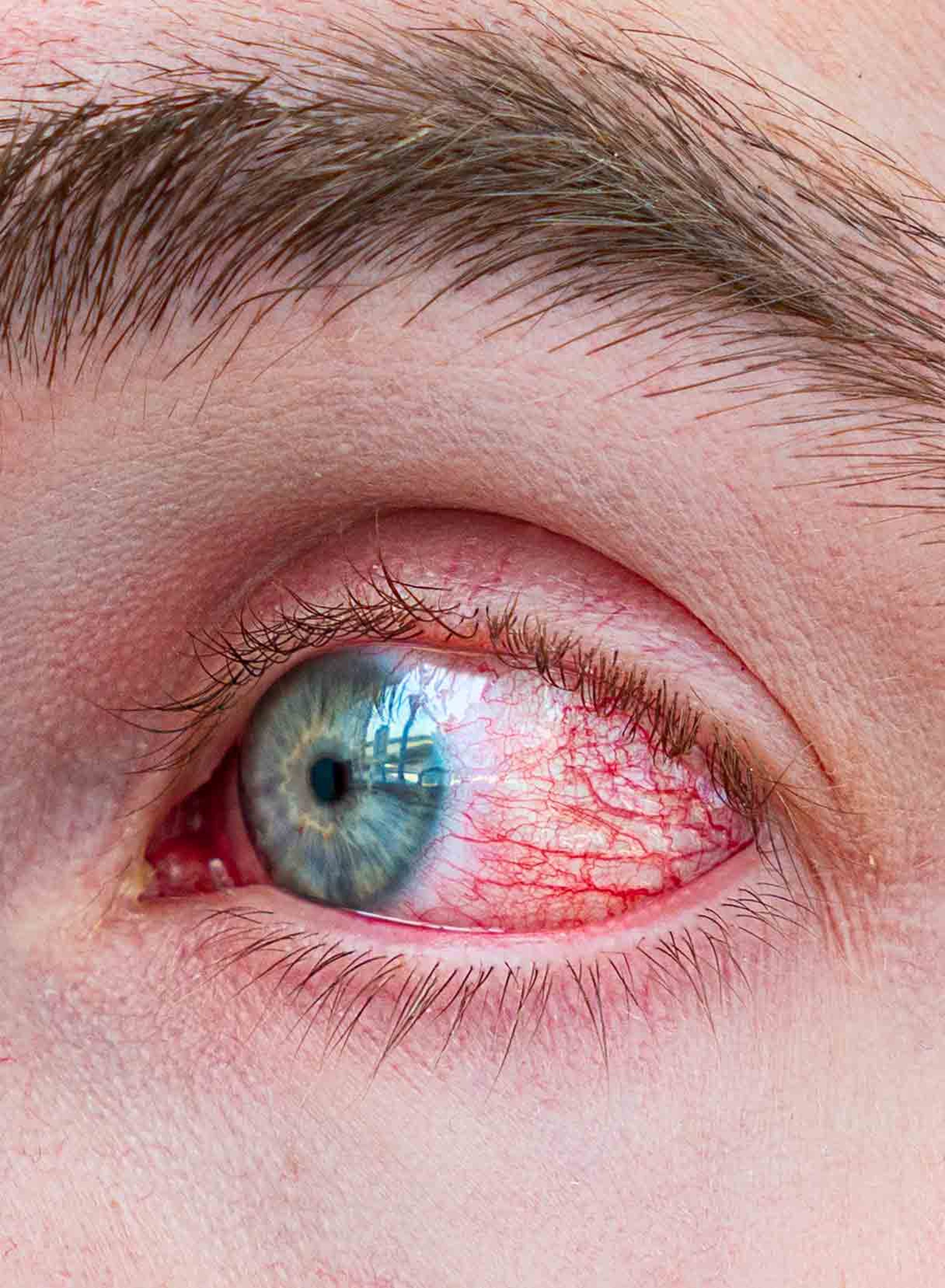 problema all'occhio dovuto ad artrite reumatoide