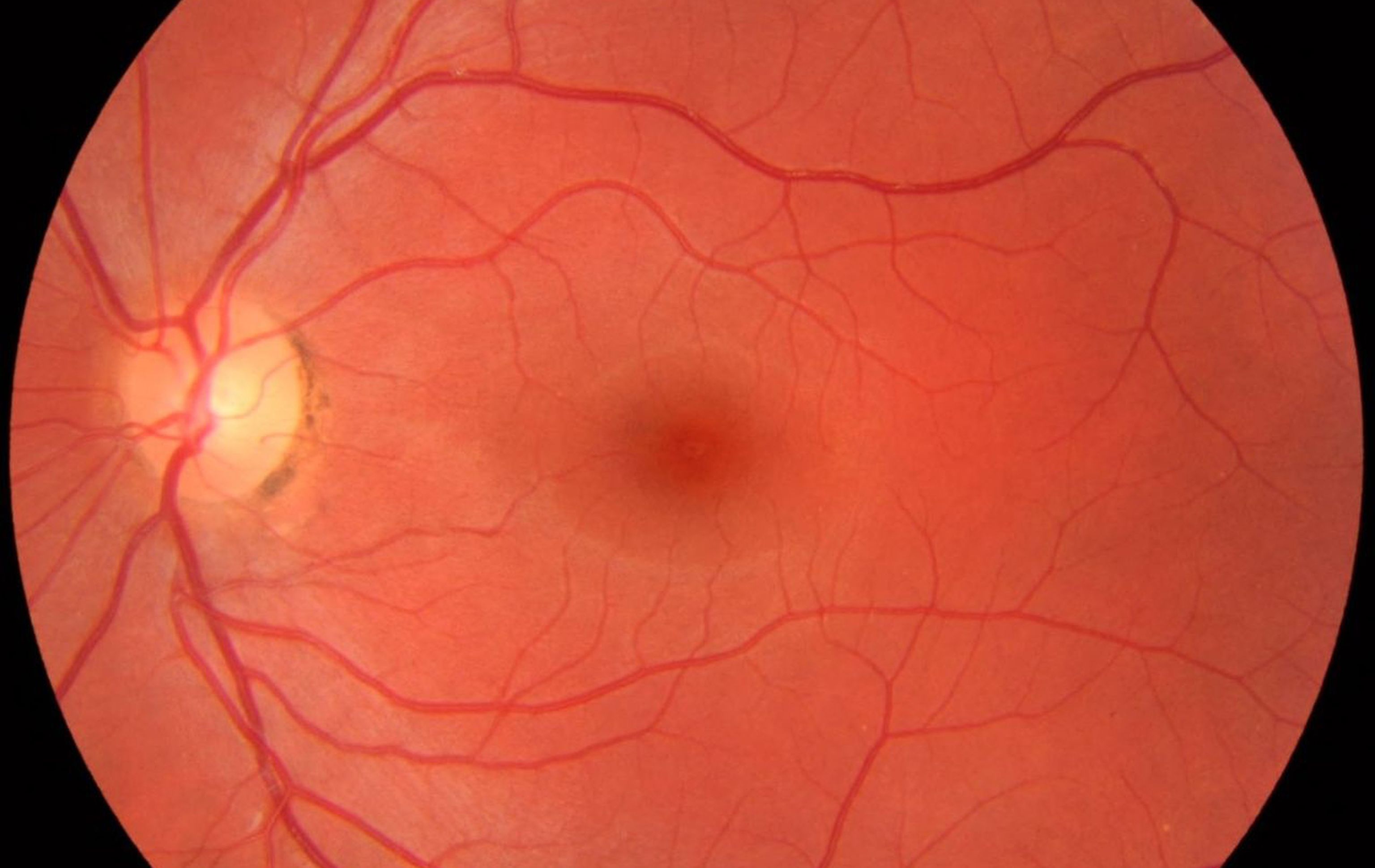 Il Fondo dell'occhio