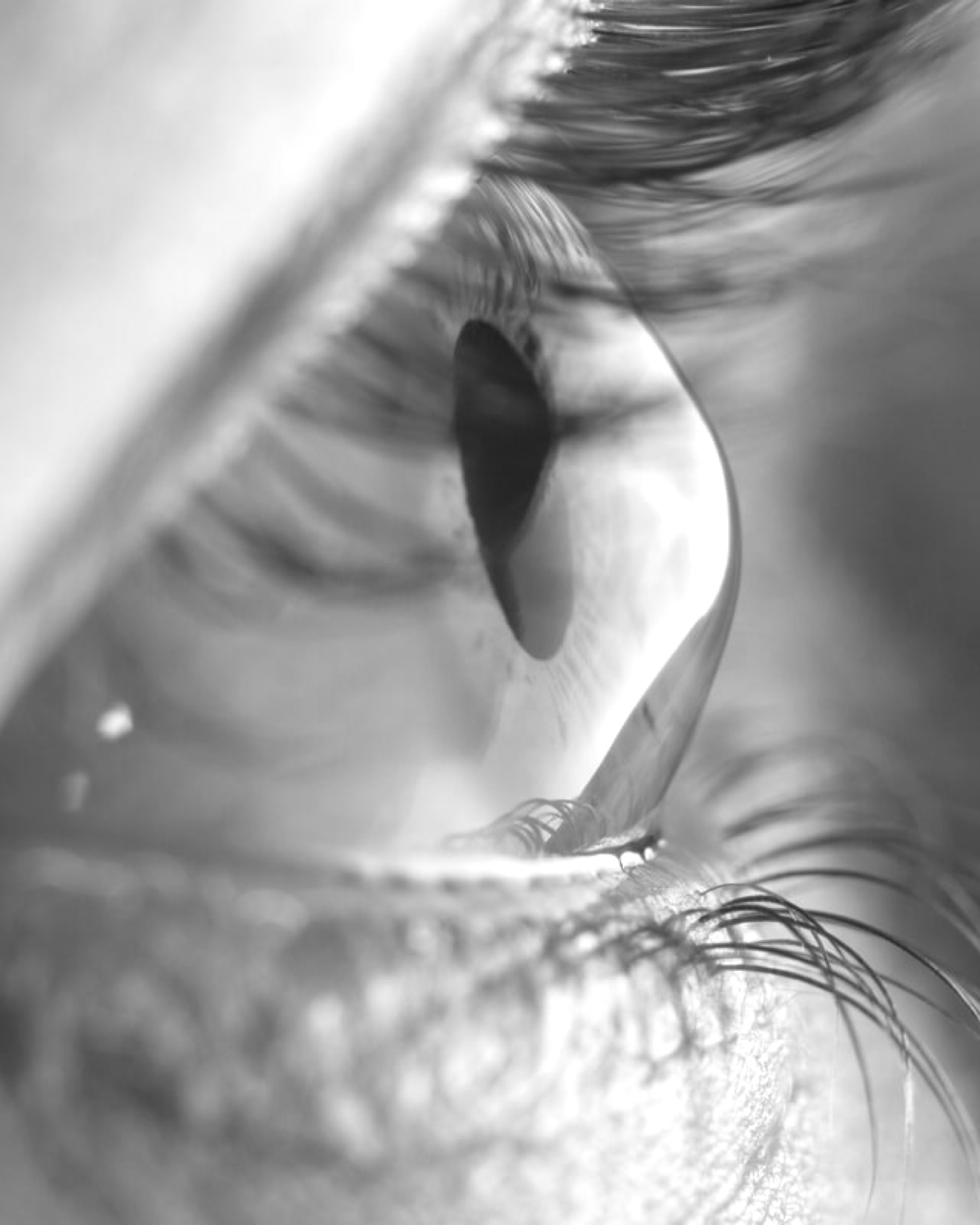 Cheratocono: le terapie