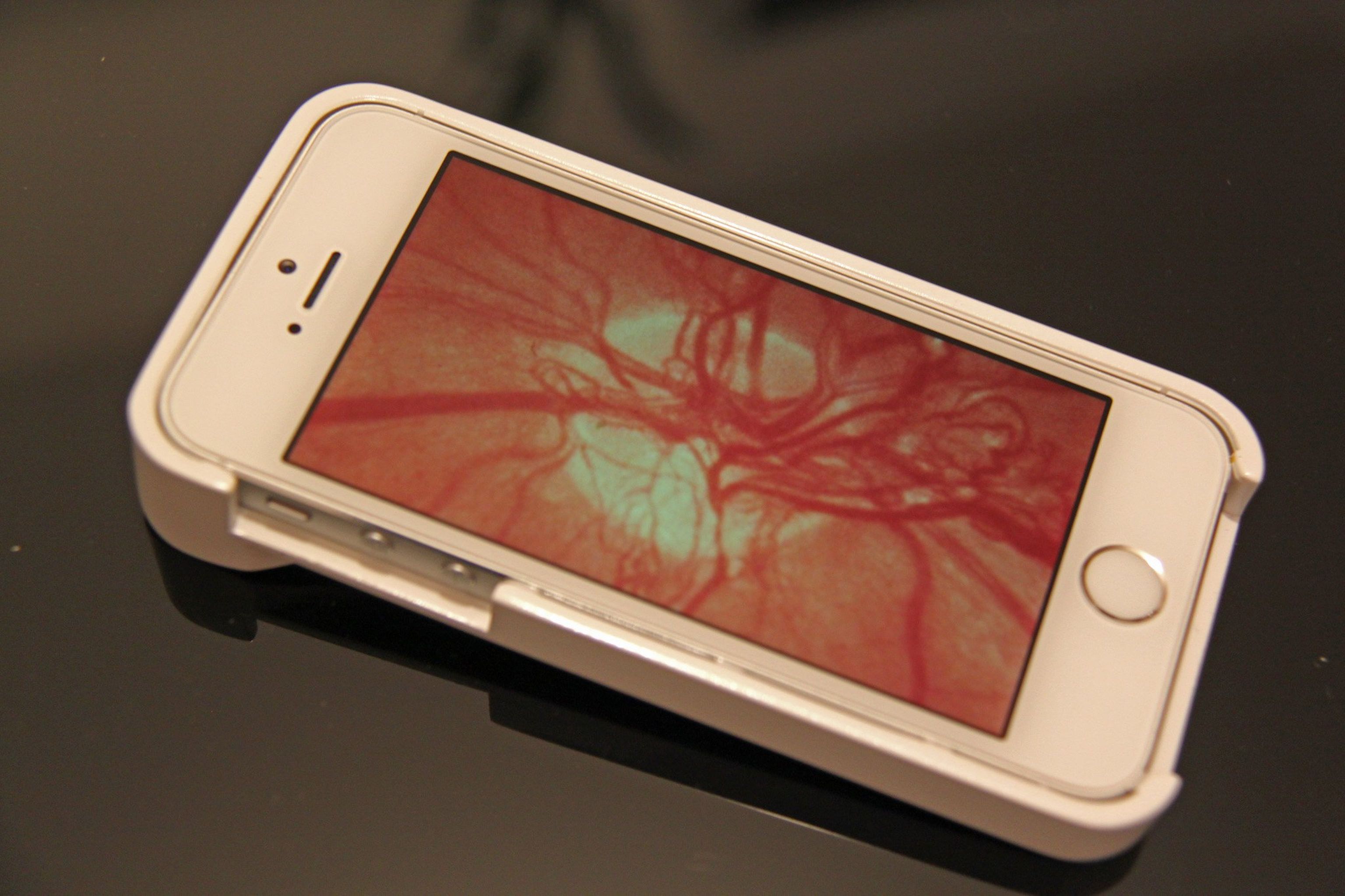 D-EYE, ottica per smartphone che fotografa la retina