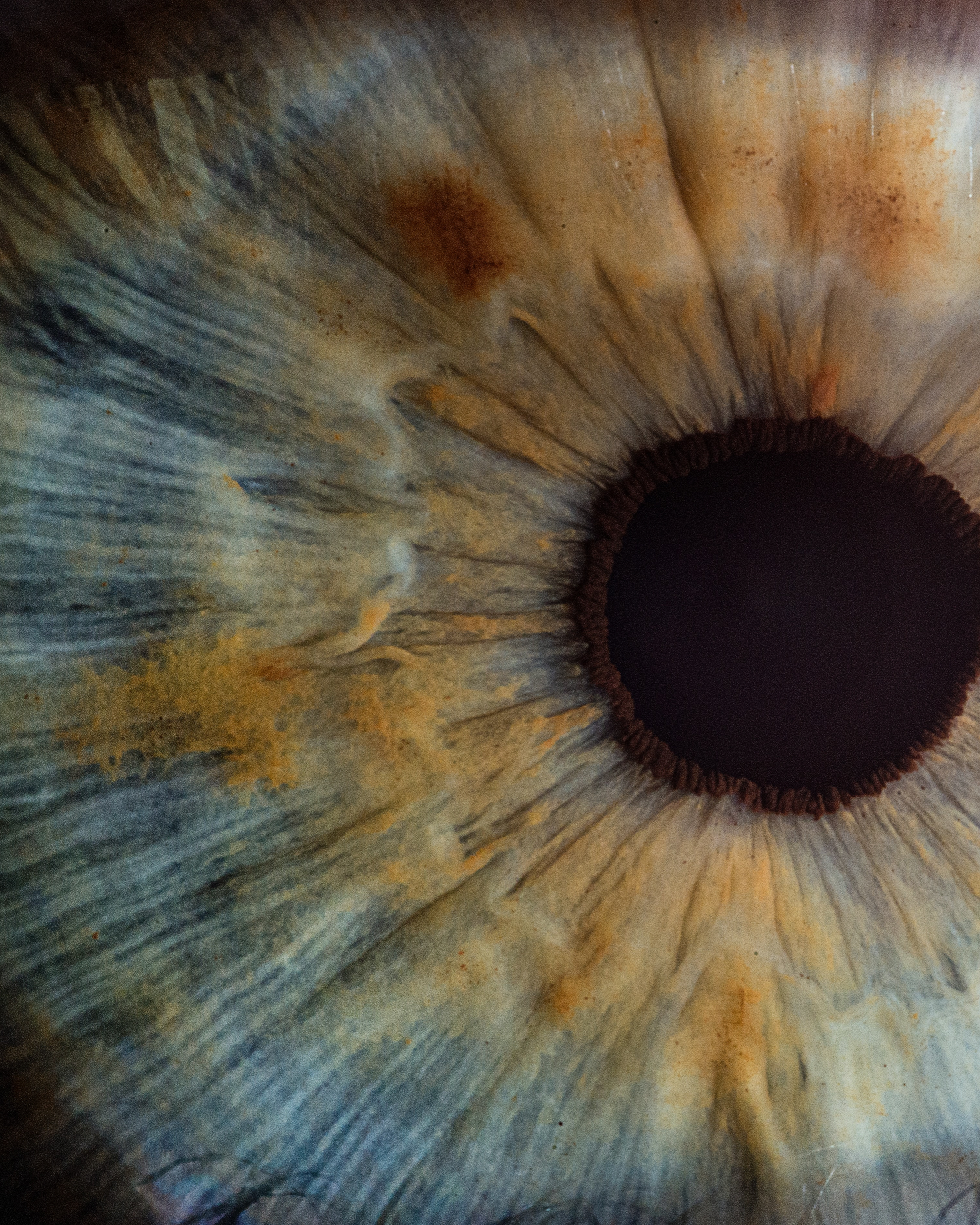 Abrasione corneale: sintomi e rimedi