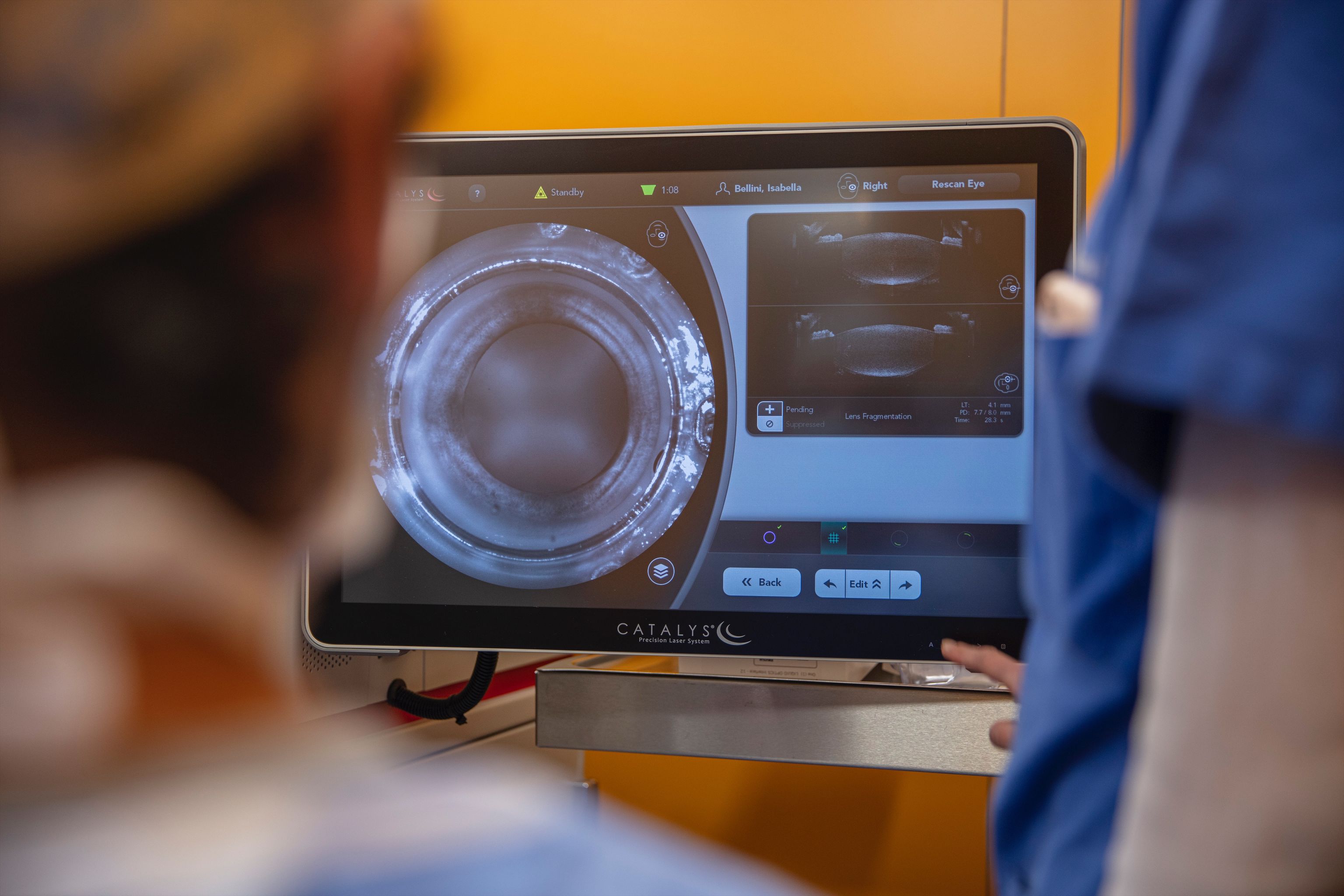 Nuove frontiere della chirurgia refrattiva: la tecnica SMILE
