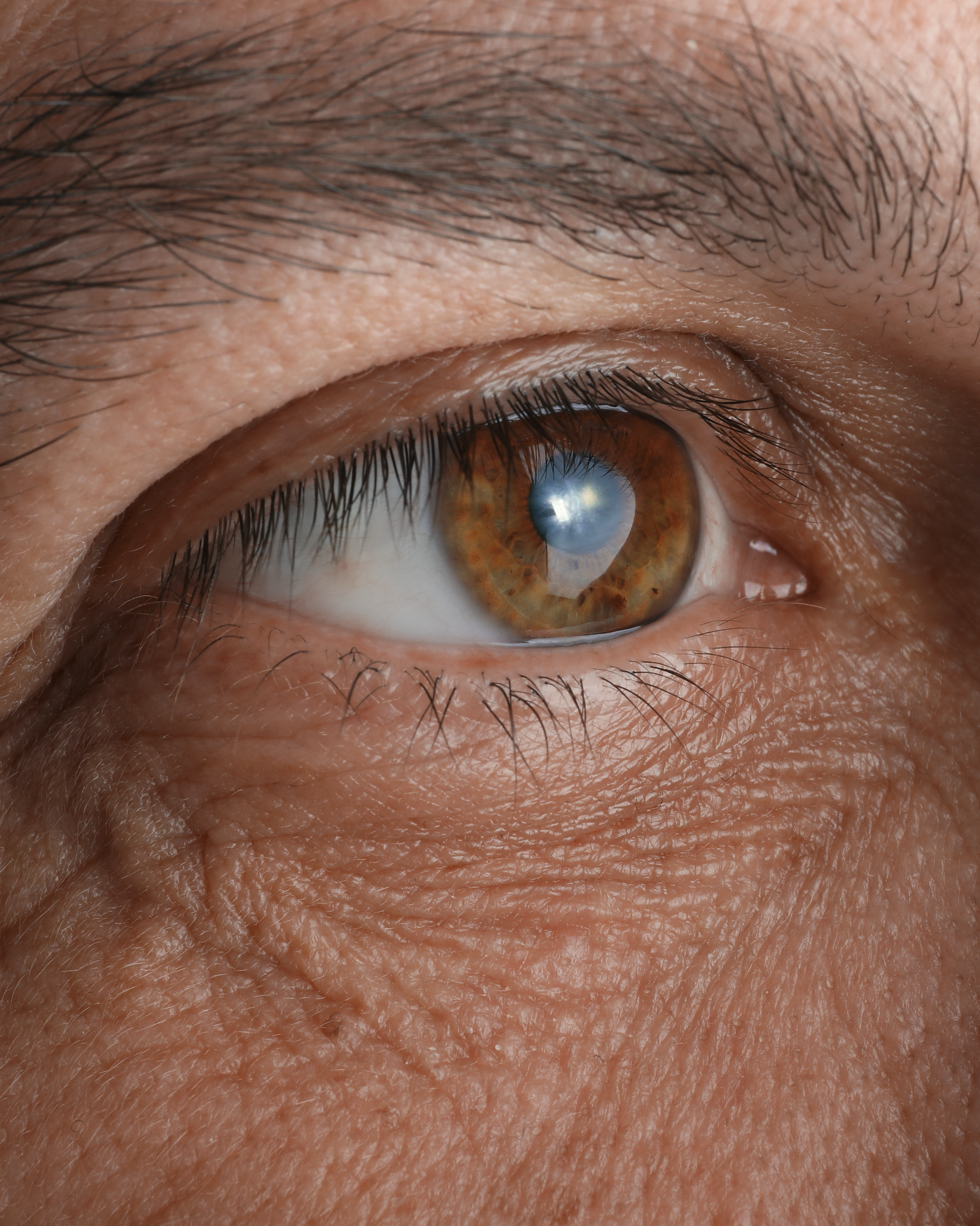 Eliminare la cataratta con il laser