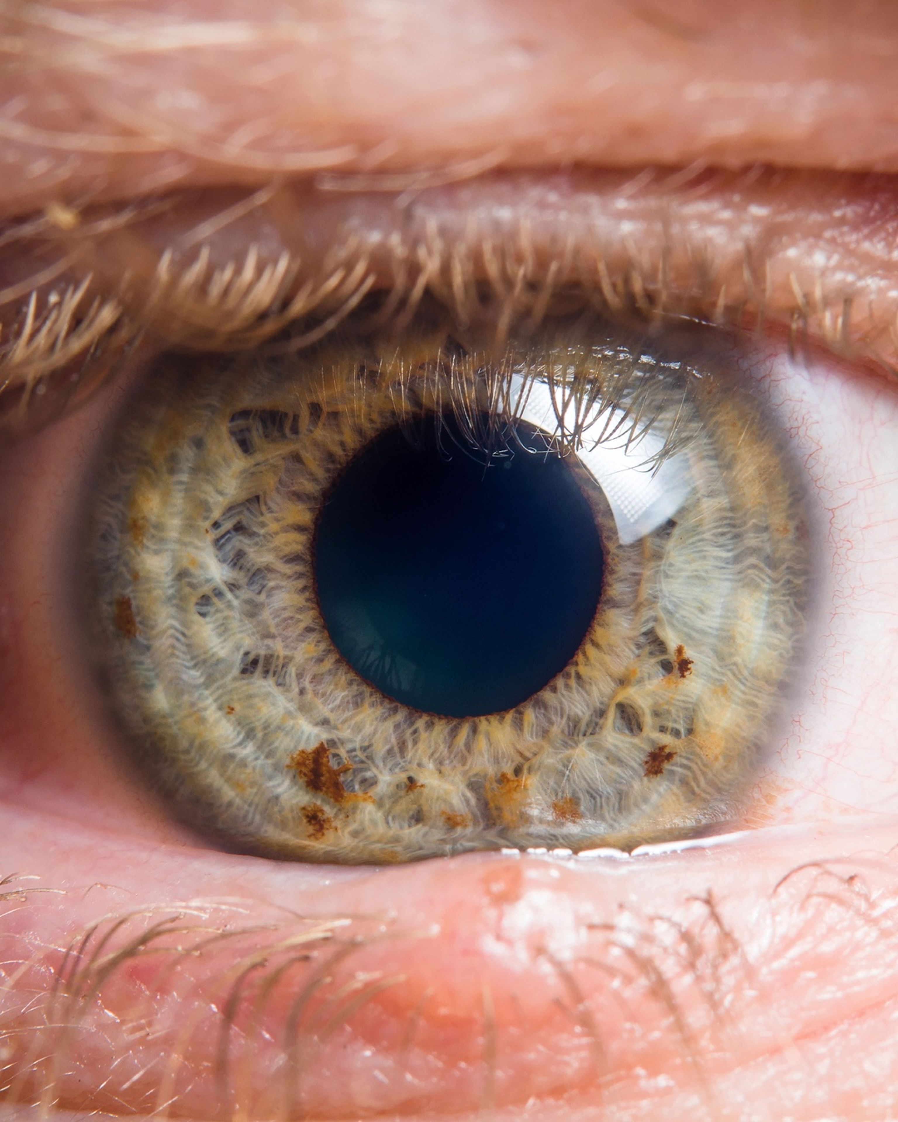 Sostituzione del cristallino