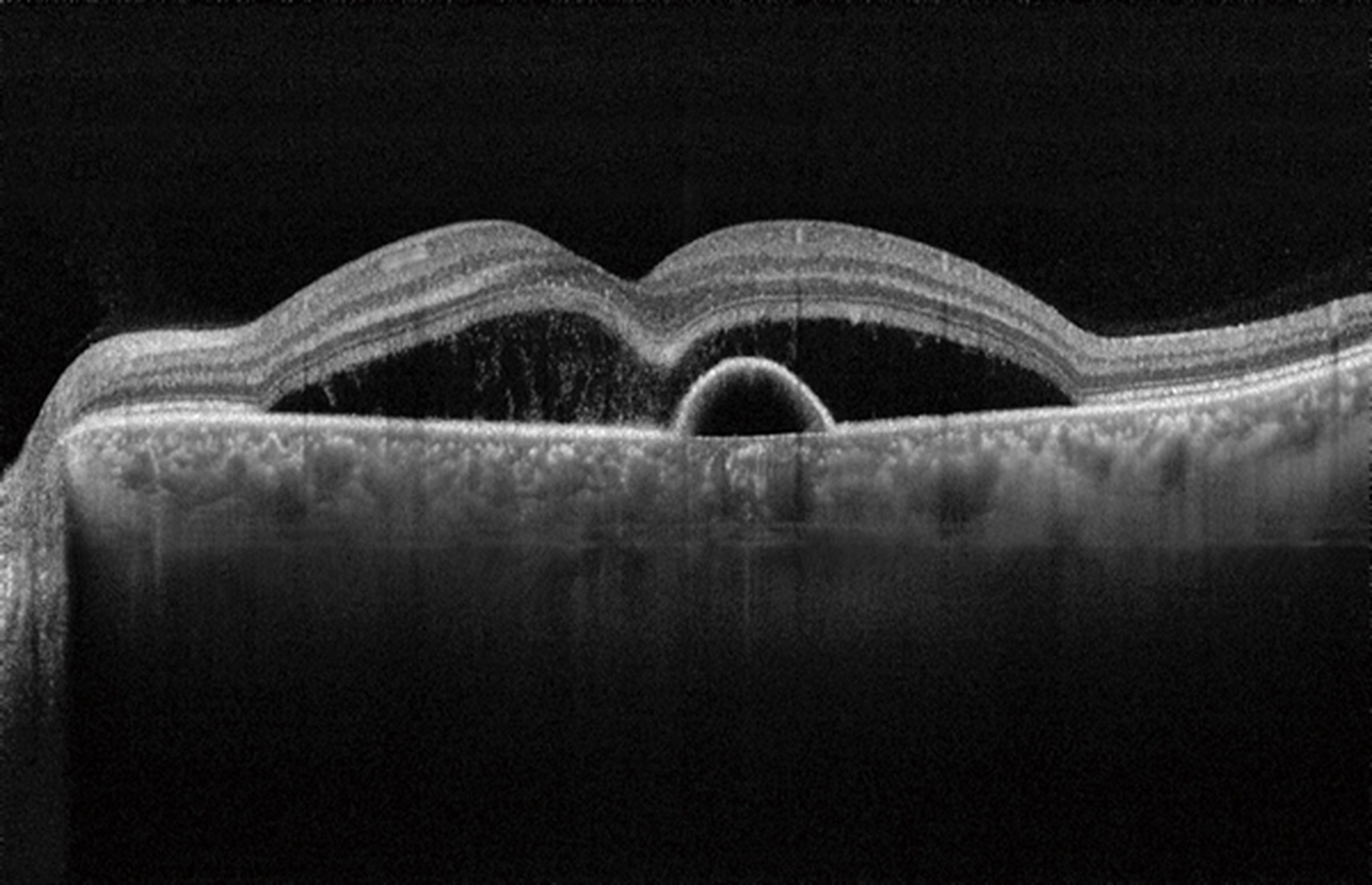 Il Dott. Andrea Russo pubblica un nuovo trattamento per la Corioretinopatia Sierosa Centrale