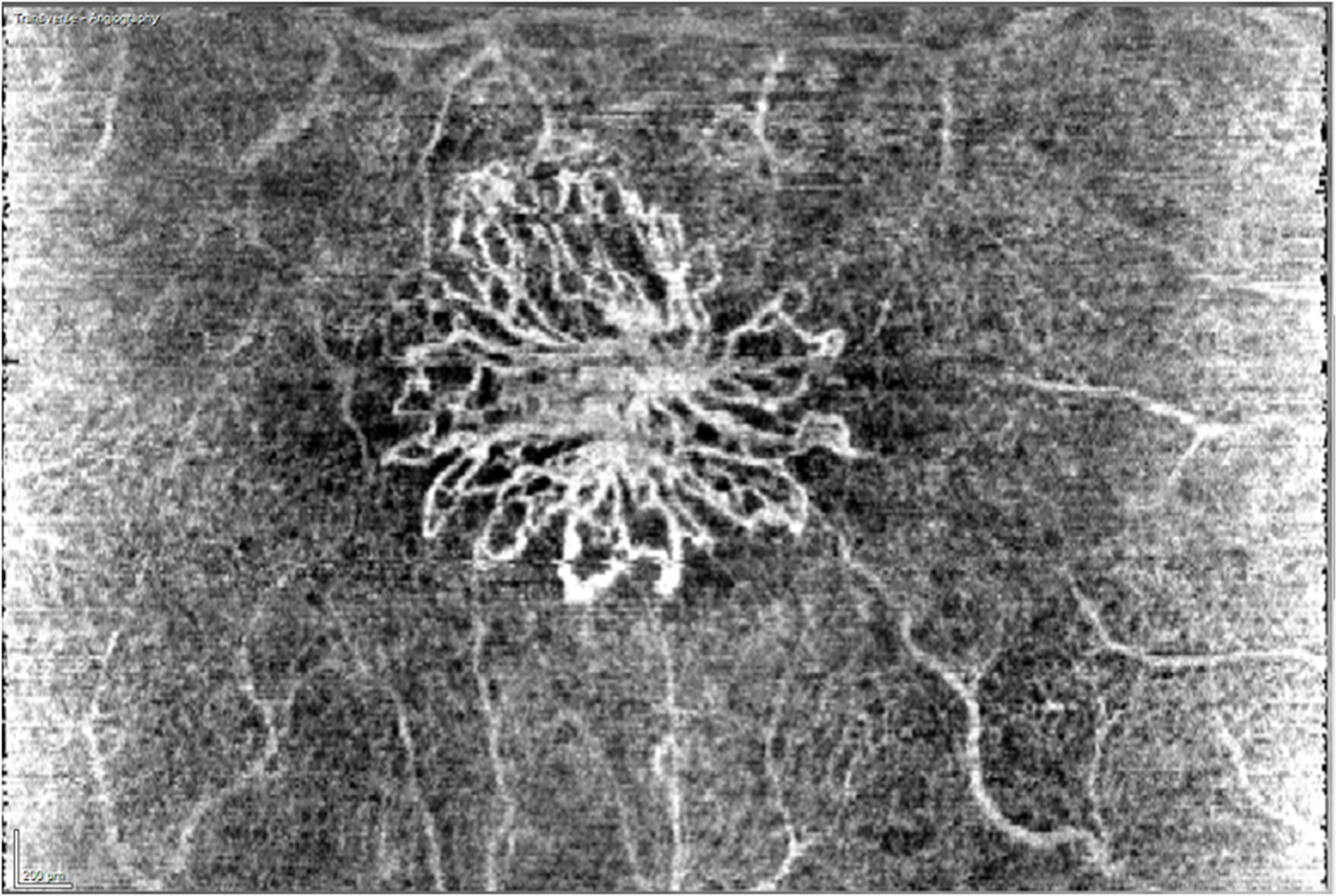 Angio OCT: la nuova frontiera della diagnostica retinica