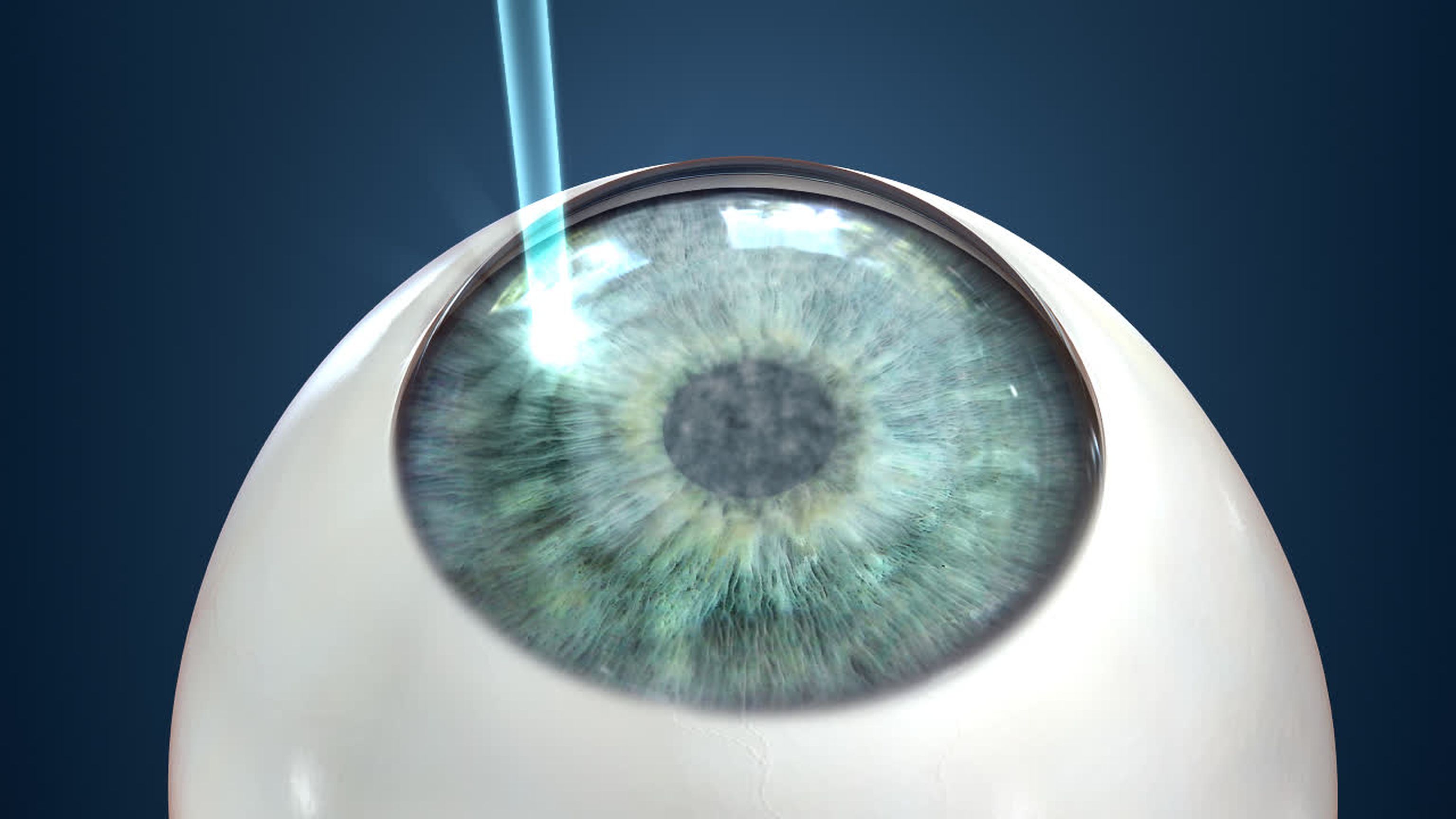 Venti anni dall’approvazione FDA della LASIK