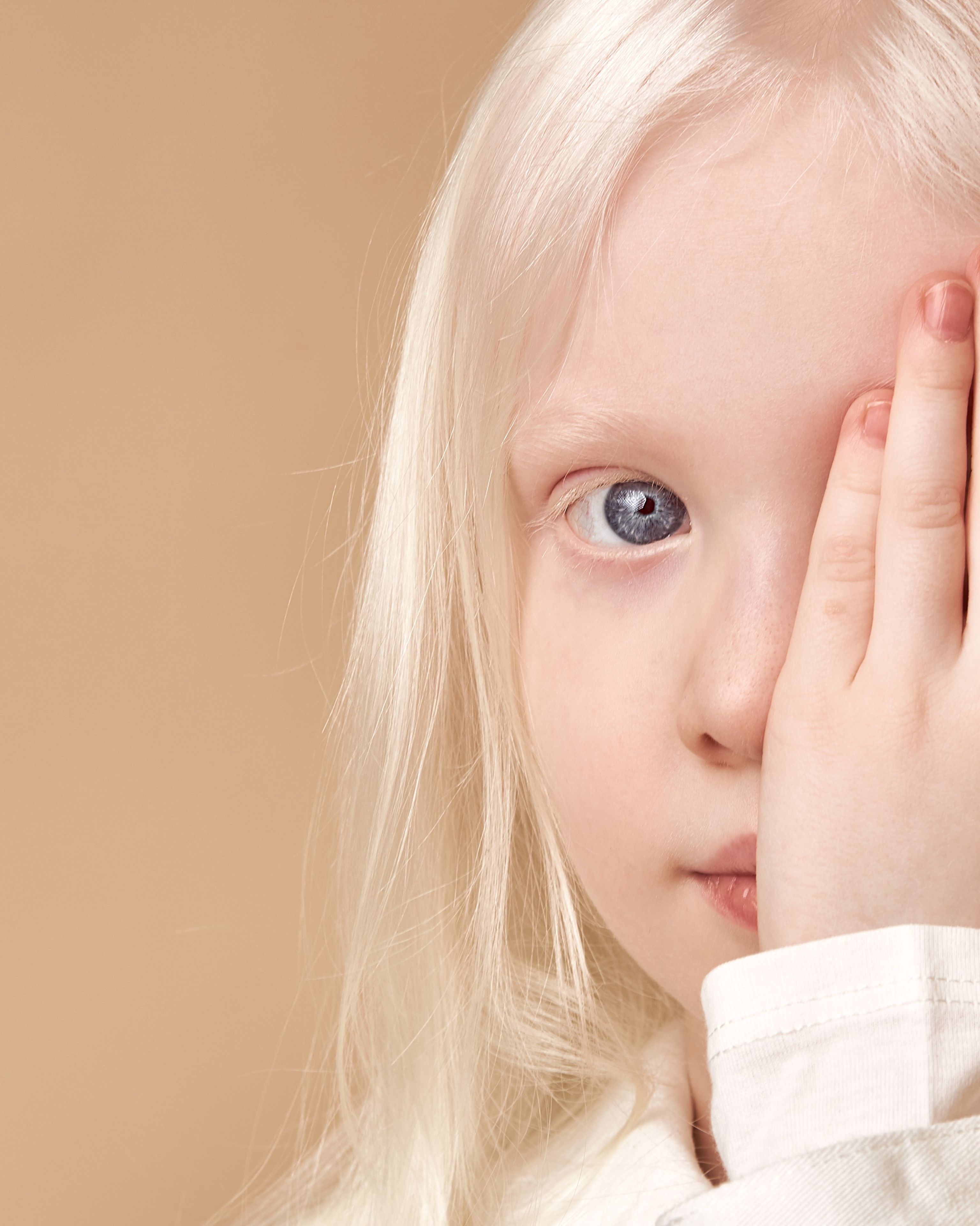 Albinismo: conseguenze sulla vista