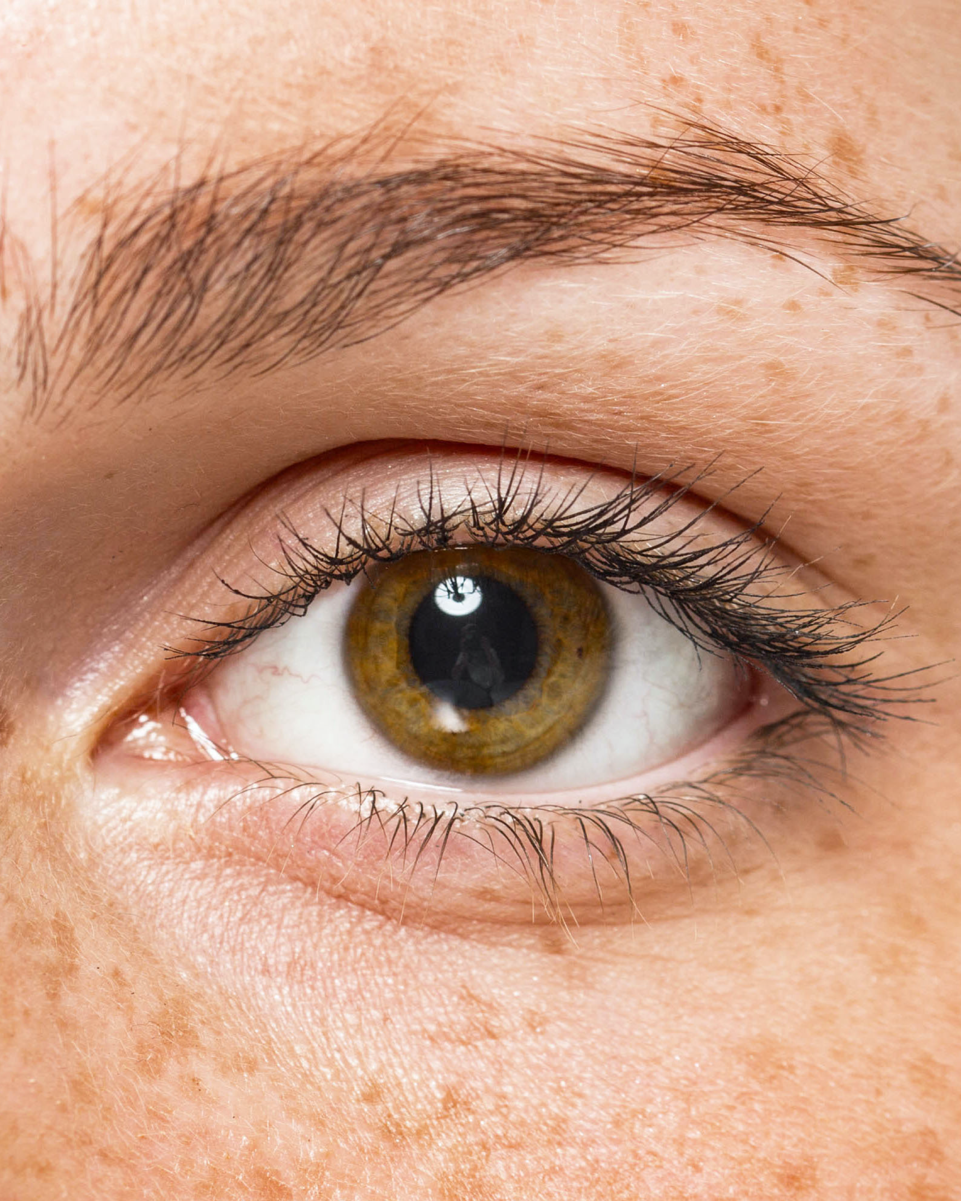 Cross-linking corneale. Che cos’è?