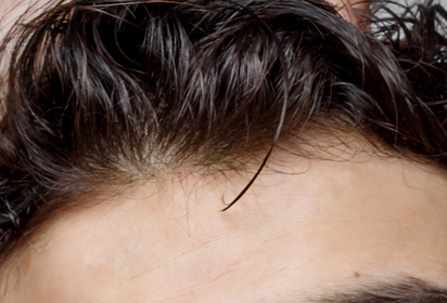 Numan hair loss treatment