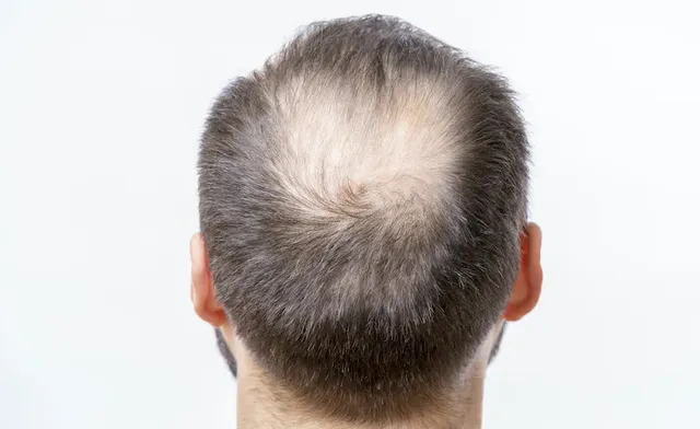 which-vitamin-deficiency-causes-hair-loss