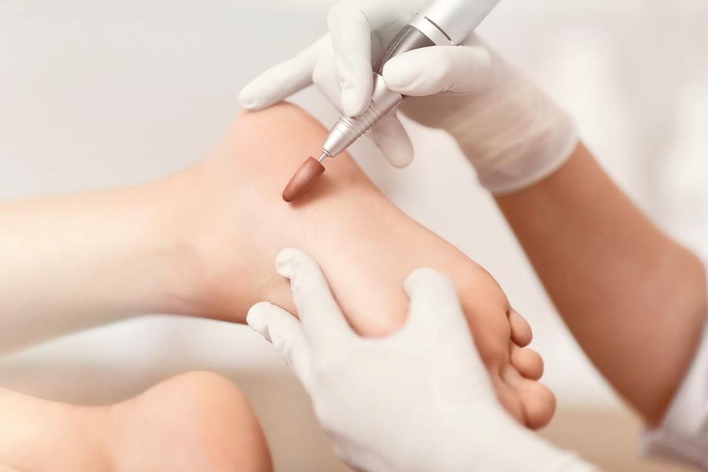 Ein Fuß, der mit einer elektrischen Pfeile behandelt wird