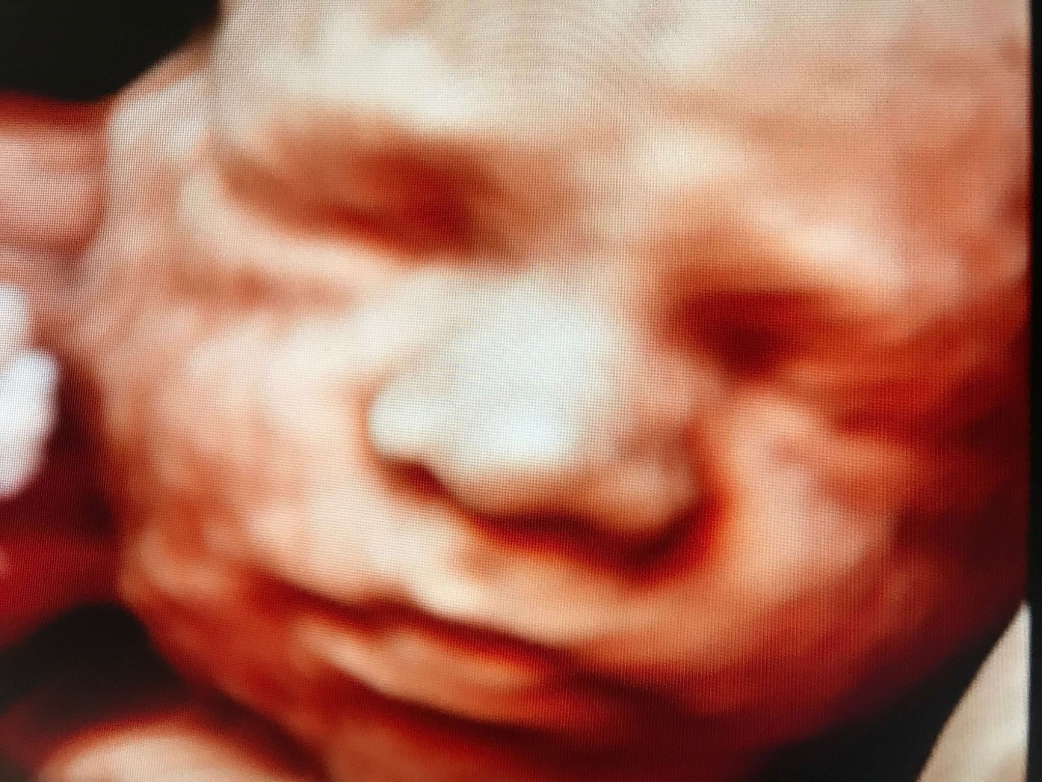 Nateo vynimočná starostlivosť v Pôrodnici Bory - 3D ultrazvuk Nateo vynimočná starostlivosť v Pôrodnici Bory - 3D ultrazvuk