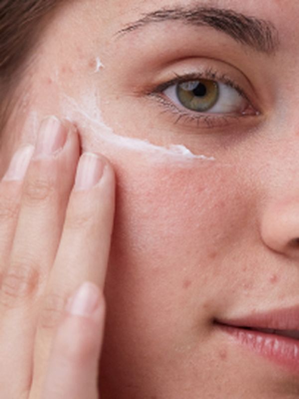 Menopause and acne: why it happens and how to treat it