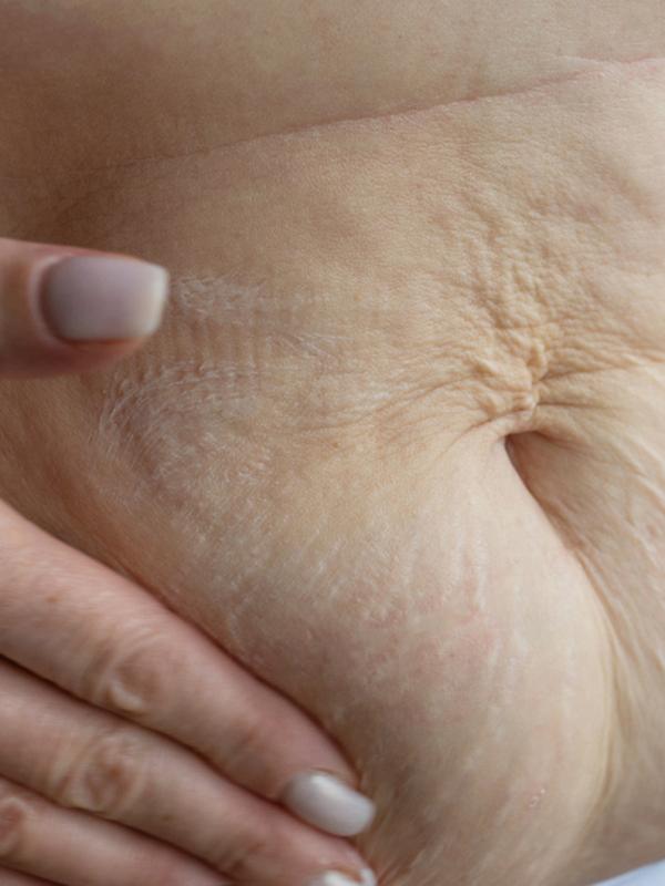 What can you do about hormonal belly fat? 