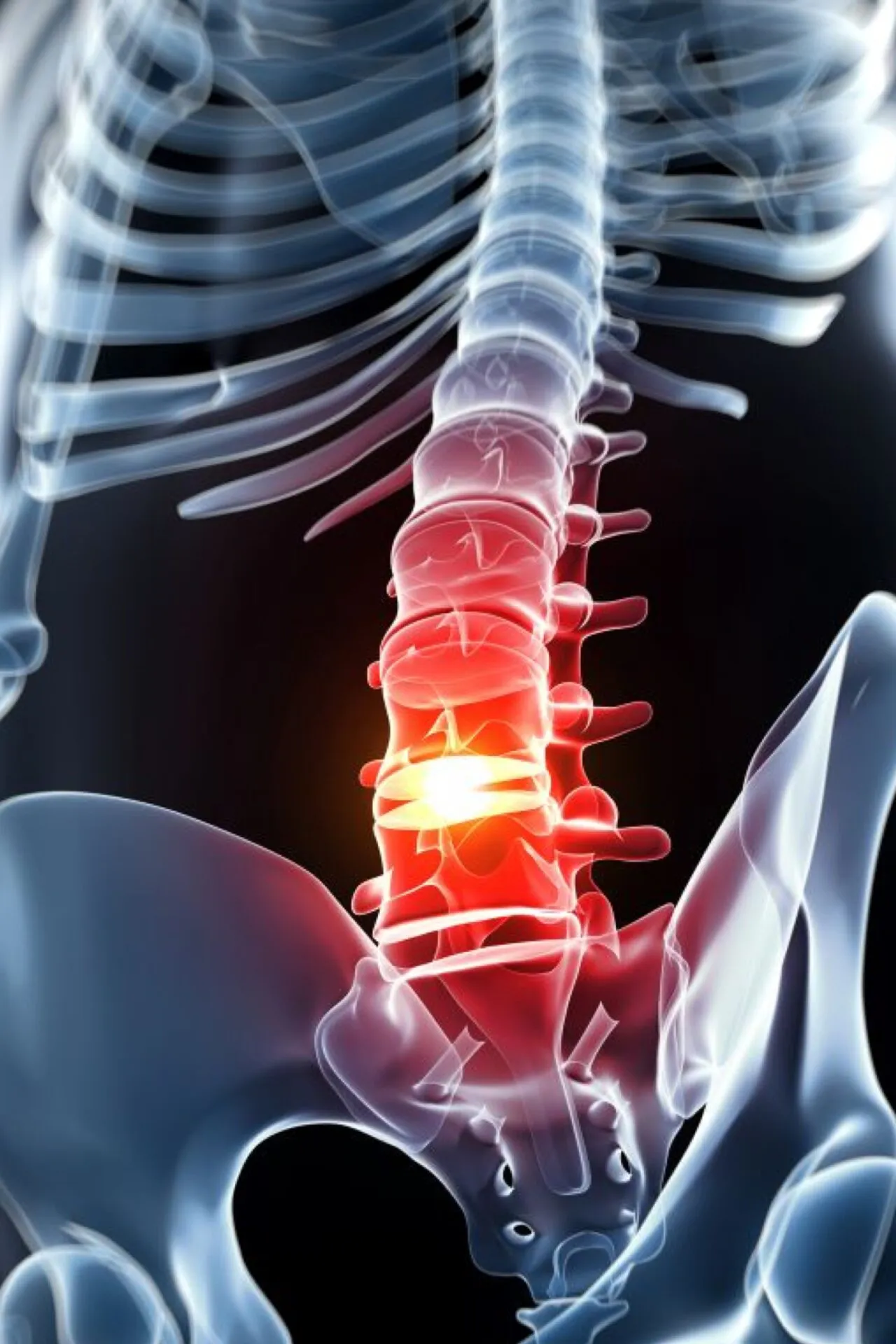 Come allenarsi in caso di ernia del disco