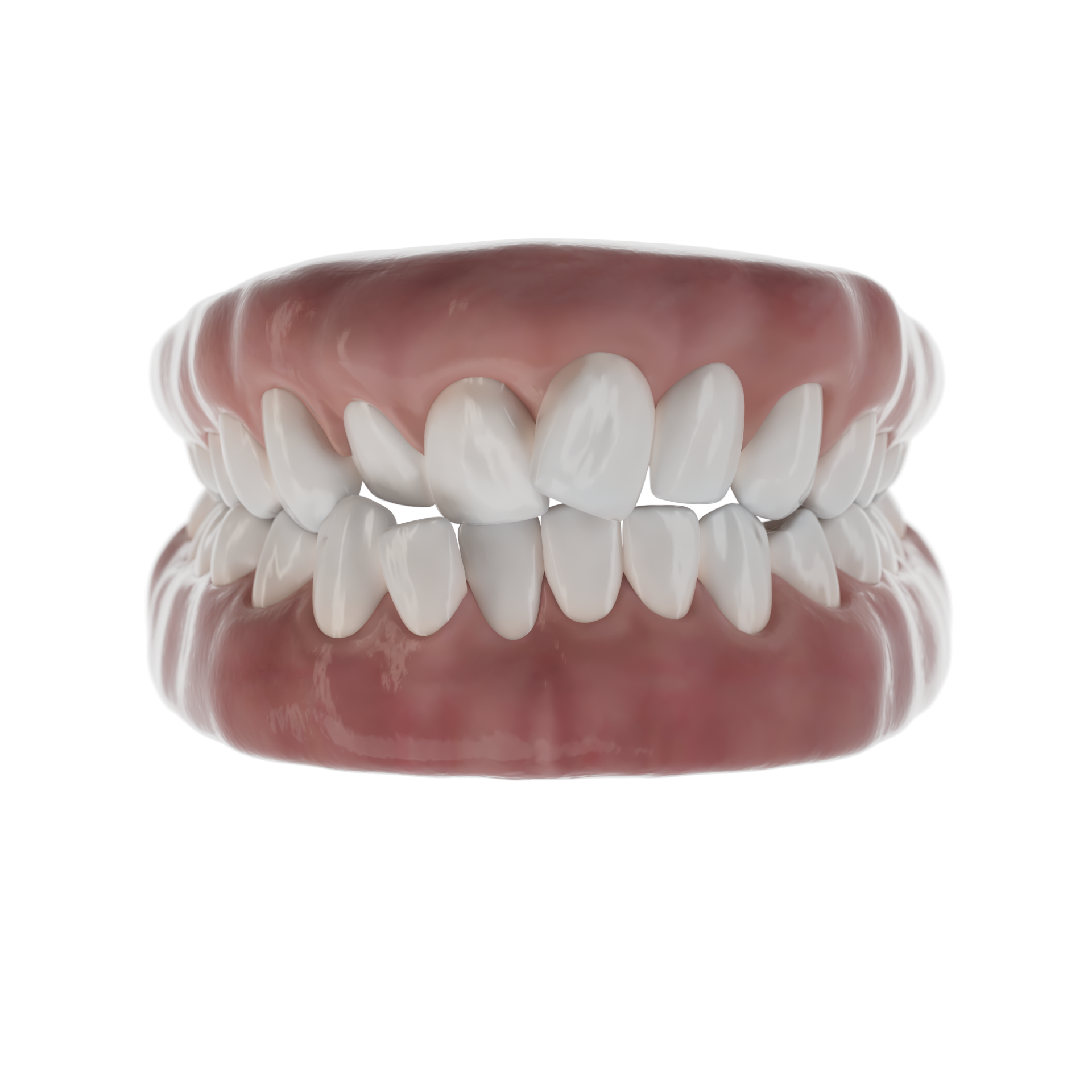 Crowding Teeth Crowded Teeth & Breathing Issues | Smiles By Bis