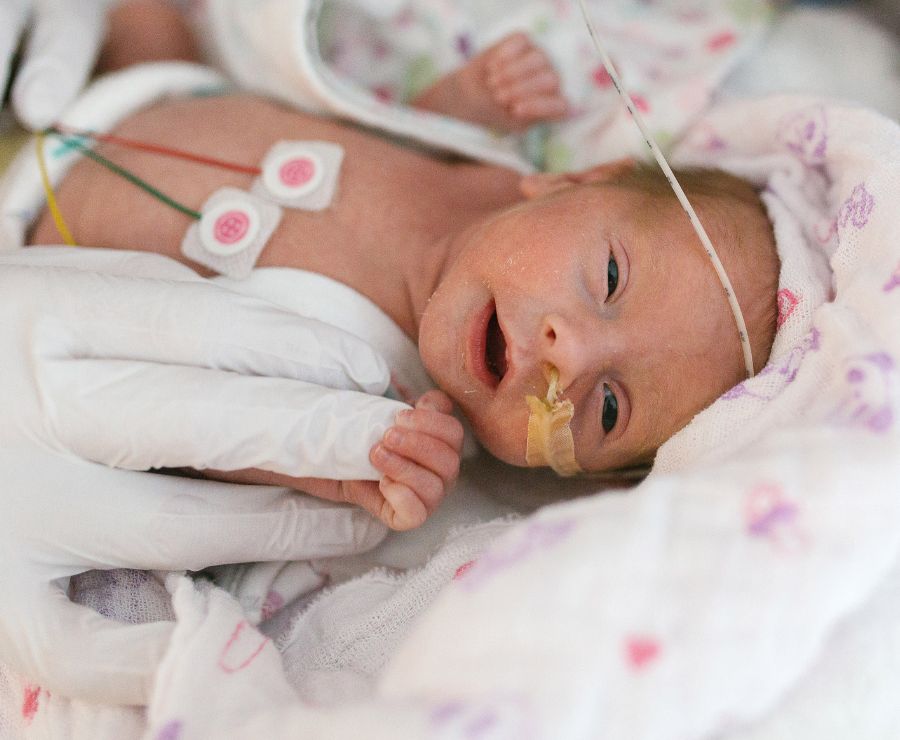 Ein Frühgeborenes mit einem Schlauch in der Nase wird auf der Neonatologie betreut.