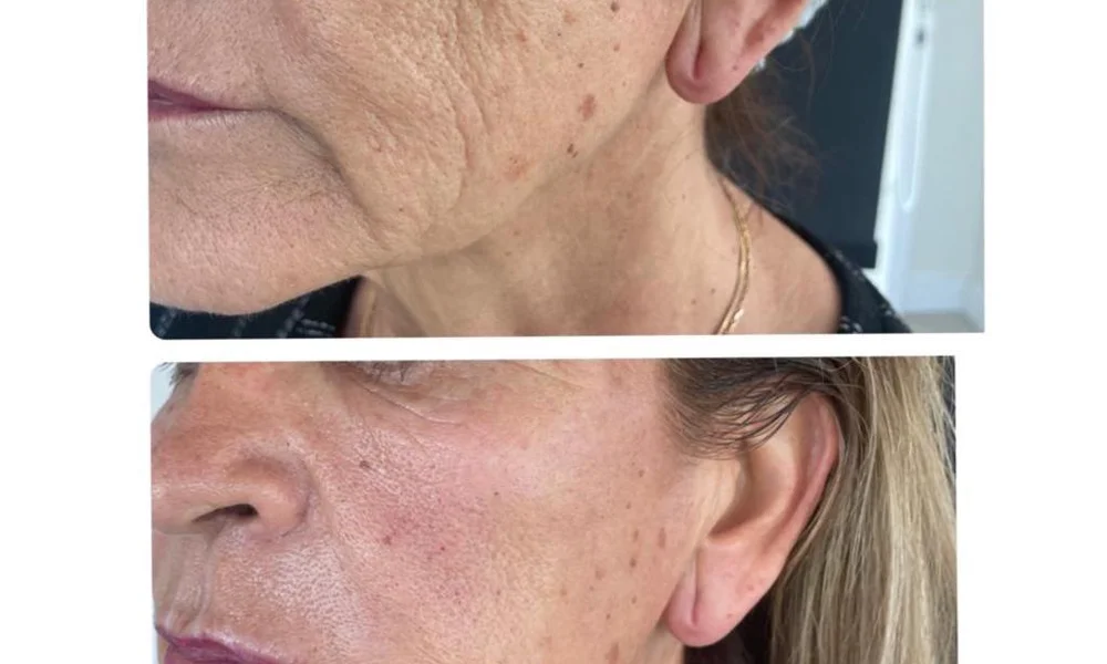 Sculptra antes y después