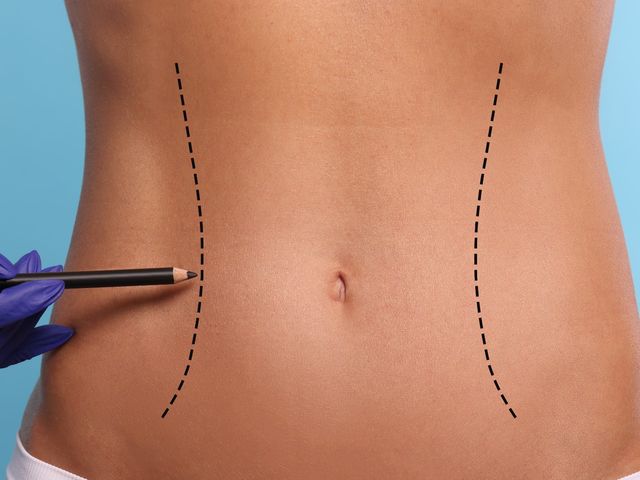 Mujer en preparación para Endolaser Corporal