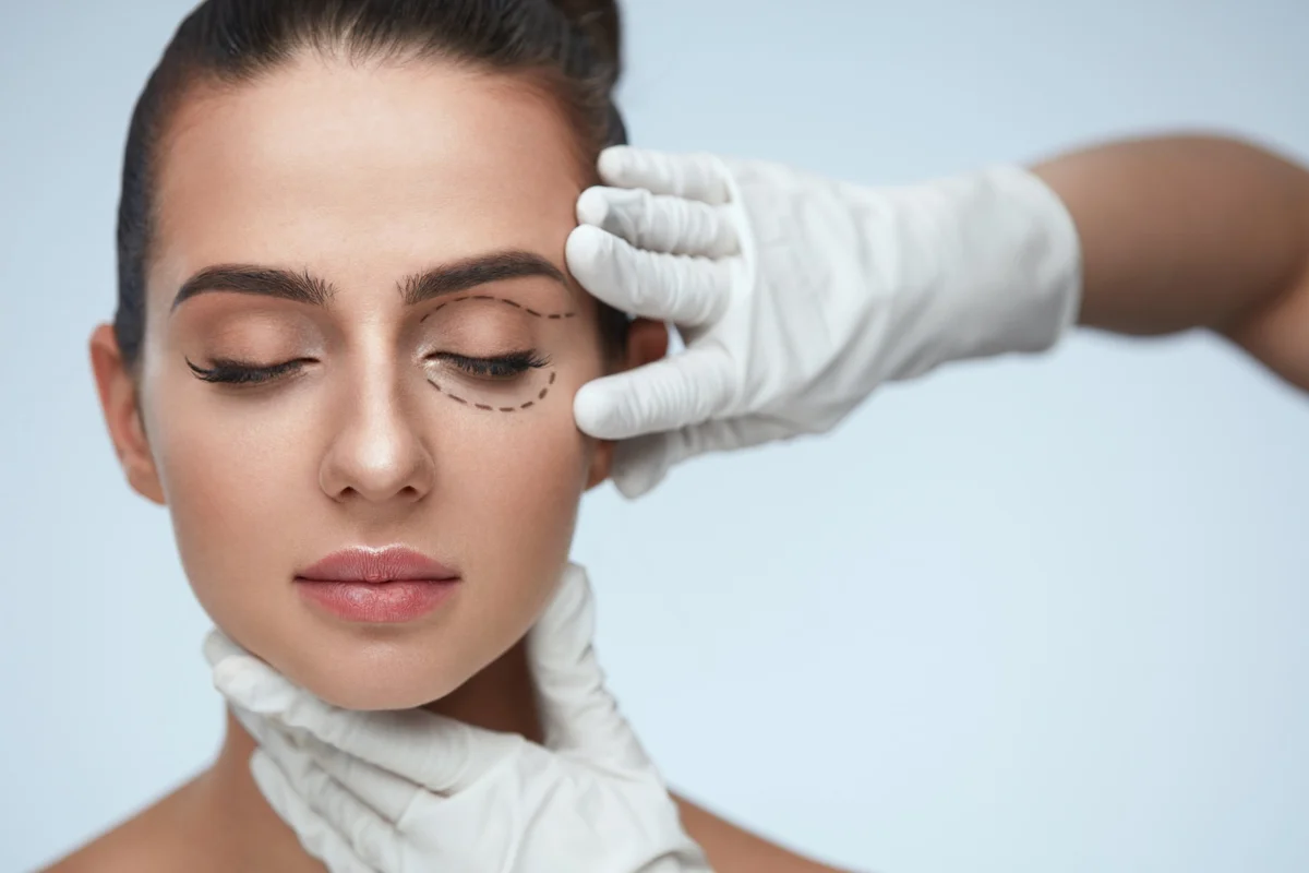 Mujer con marcas en el rostro en preparación para para tratamiento de blefaroplastia no quirúrgica