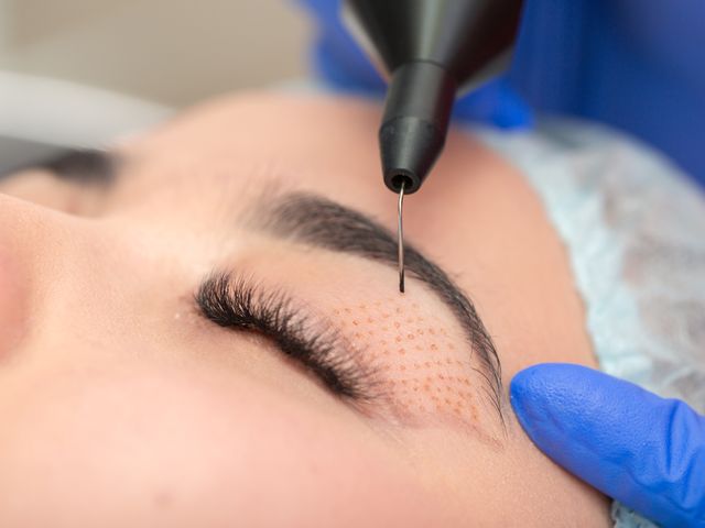 Blefaroplastia sin cirugía para rejuvenecimiento de párpados caídos