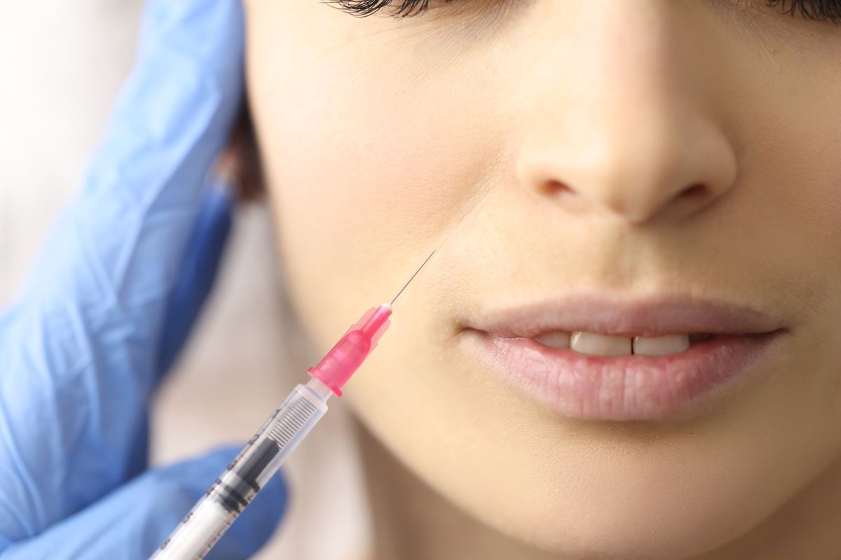 Procedimiento de relleno facial con ácido hialurónico para suavizar líneas de expresión en el rostro