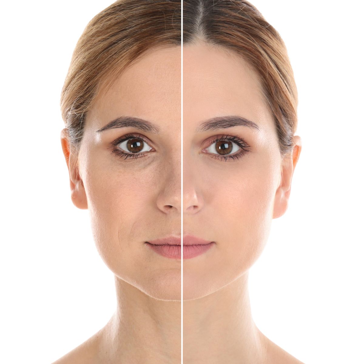 Mujer endolifting facial antes y después