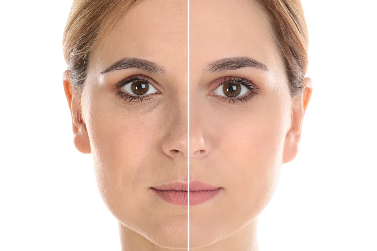 Mujer endolifting facial antes y después