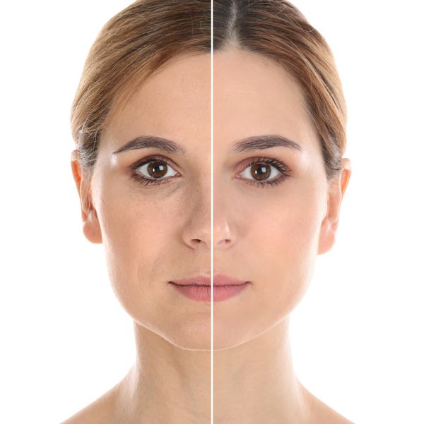 Mujer endolifting facial antes y después