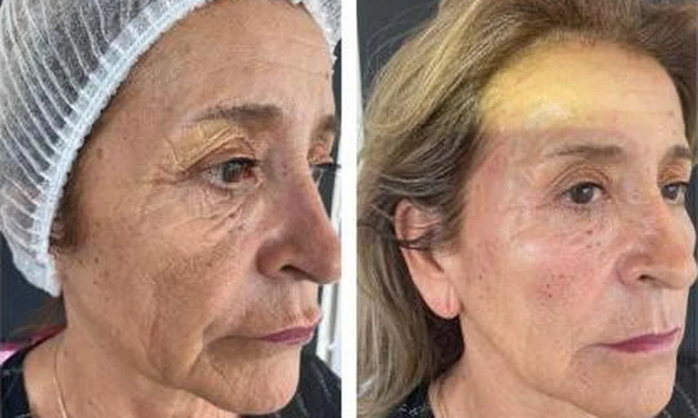Paciente Clínica Dra Zaror Rellenos faciales antes y después