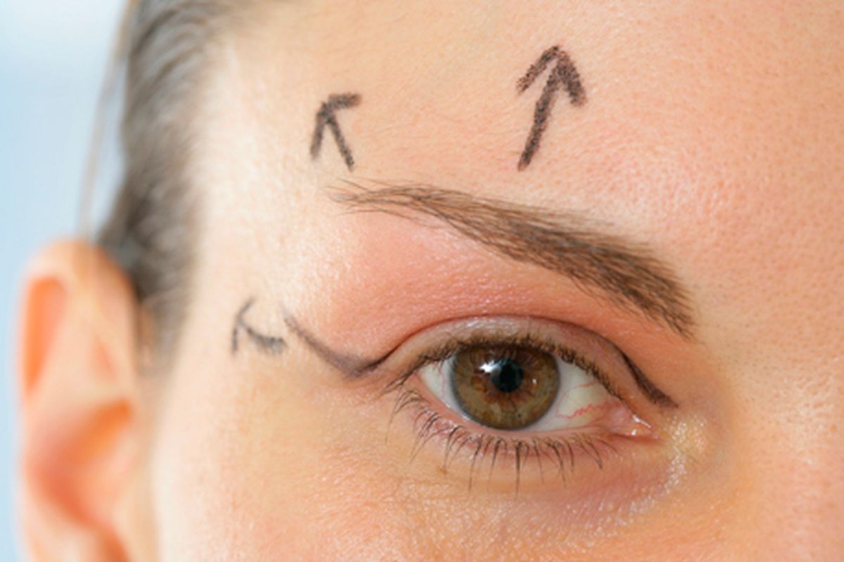 Marcación en párpado superior para blefaroplastia sin cirugía mostrando direcciones de estiramiento de la piel