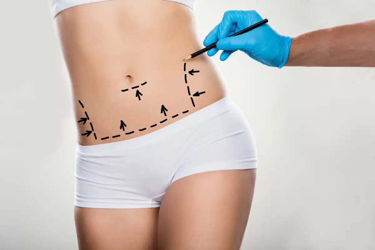 featured image for how long does it take to recovery from a tummy tuck