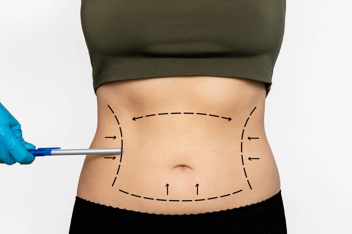 Featured image for  Top Surprising Benefits of Liposuction 