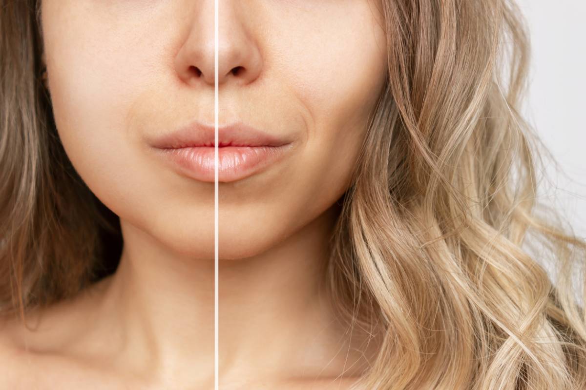 Featured image for  How Buccal Fat Removal Changes Facial Shape 