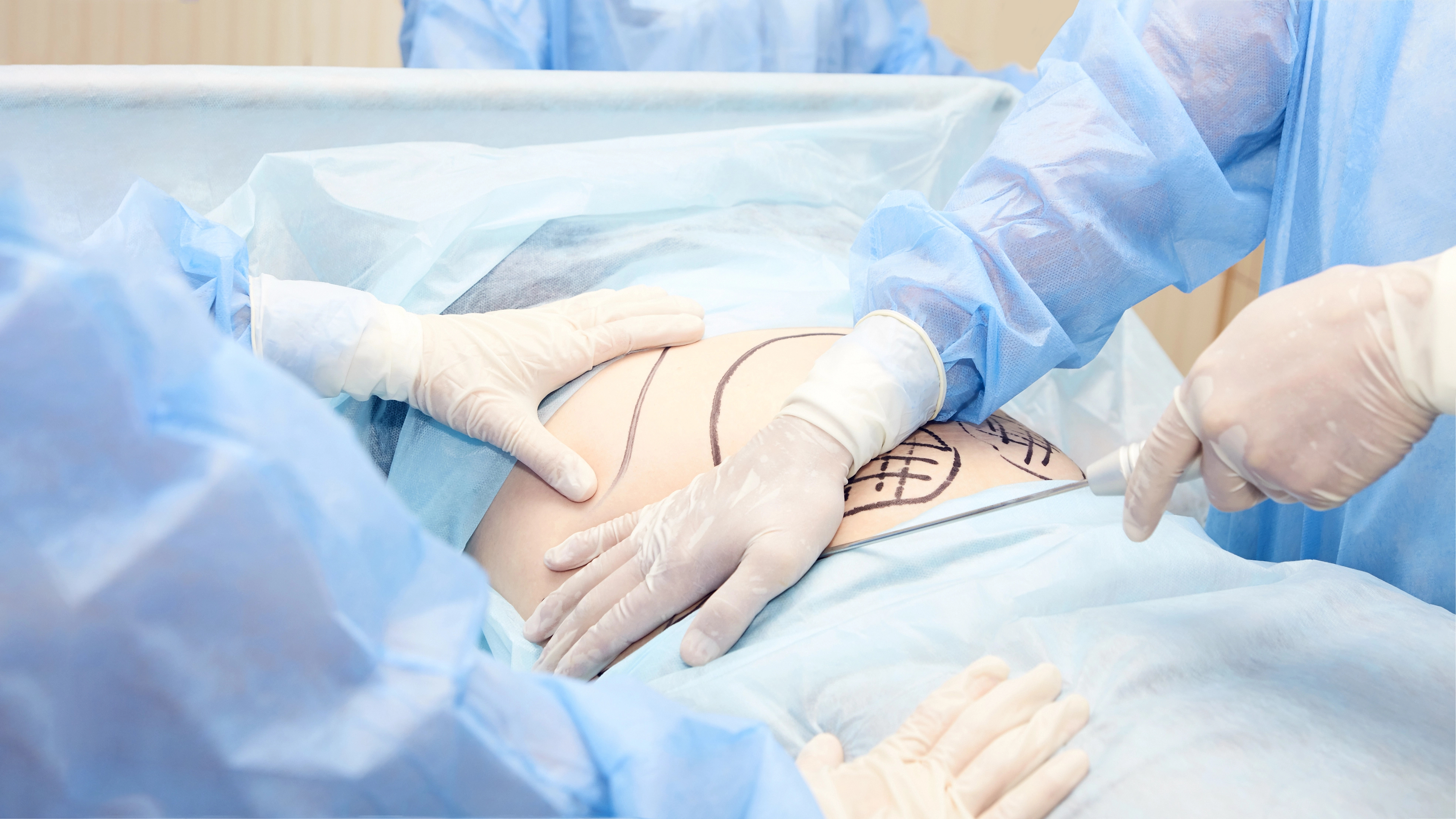 Medical team in surgical gowns marking a patient's abdomen before surgery.