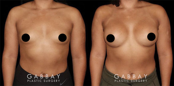 Patient 01 Front View Breast Augmentation with Lift Before and After Gabbay Plastic Surgery