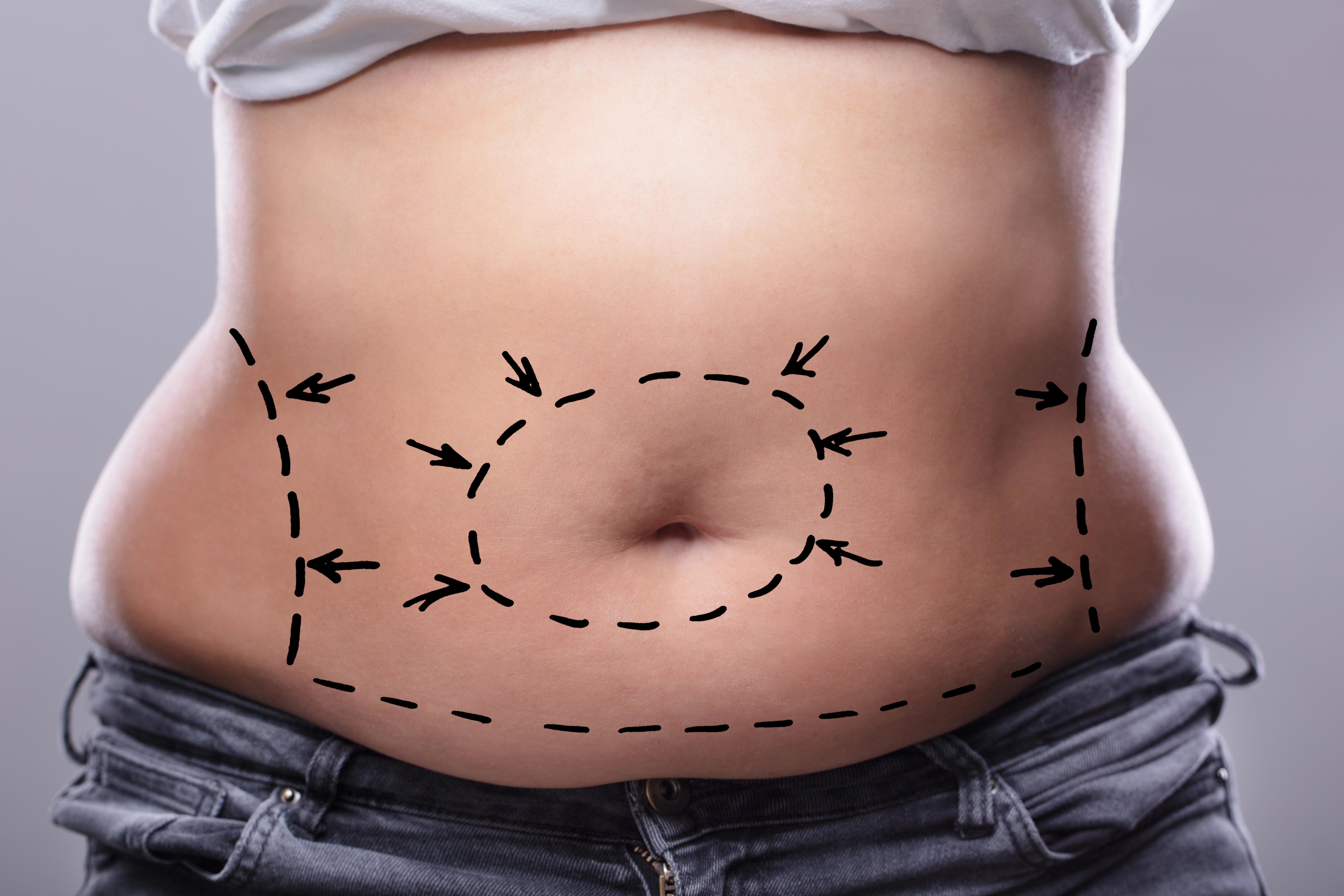 Featured image for What Is Liposuction? Techniques, Recovery, Risks, and Cost