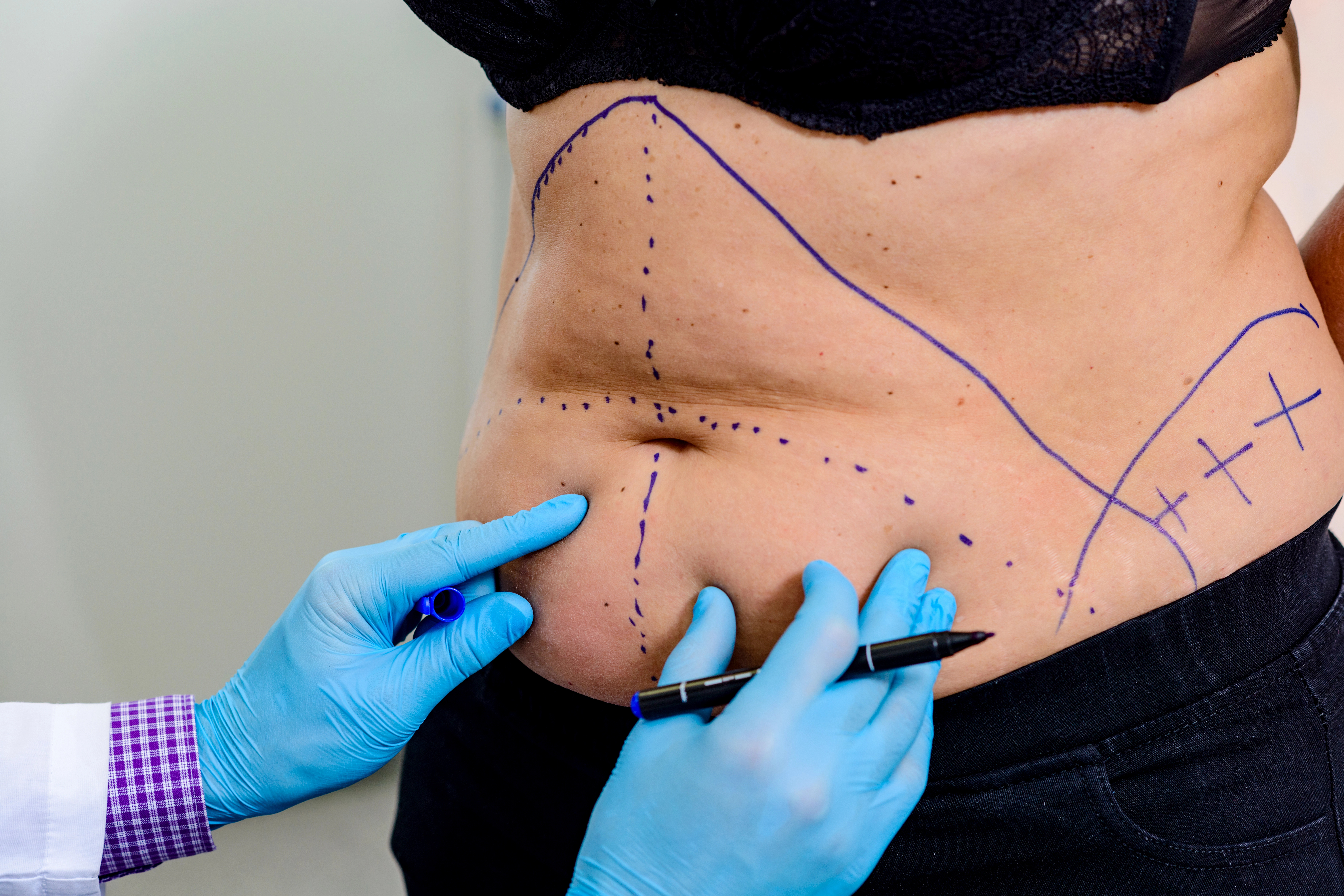 Person with surgical markings on the abdomen, indicating planned cosmetic surgery, with gloved hands pointing at specific areas.