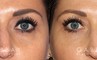 Patient 02 Front View Upper Eyelid Blepharoplasty with Fat Transfer to Face Gabbay Plastic Surgery