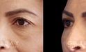 Patient 01 3/4th Left Side View Blepharoplasty Gabbay Plastic Surgery