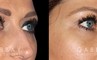 Patient 02 3/4th Right Side View Upper Eyelid Blepharoplasty with Fat Transfer to Face Gabbay Plastic Surgery