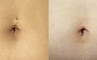 Belly Button Piercing Removal Before and After Gabbay Plastic Surgery
