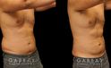Late 30s male patient before and after male liposuction. Targeted fat removal resulted in a flatter abdomen and significant reduction of flank volume. Note the reduction of waist curves for a straighter silhouette.