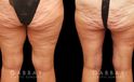 Patient 02 Back View Thighplasty and Knee Liposuction Gabbay Plastic Surgery