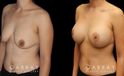 Scar revision to breasts results with additional breast augmentation and lift combination. Patient improved breast size and position with mild scarring only.