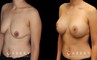 Scar revision to breasts results with additional breast augmentation and lift combination. Patient improved breast size and position with mild scarring only.