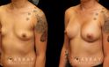 Silicone implants were used to increase breast roundness and volume. Note how the breasts kept their position while filling out for a balanced appearance.
