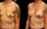 Silicone implants were used to increase breast roundness and volume. Note how the breasts kept their position while filling out for a balanced appearance.
