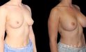 Smoother recovery for patient who chose silicone implants for breast augmentation. Breast position was maintained to keep a natural look that enhances her body type’s contours.
